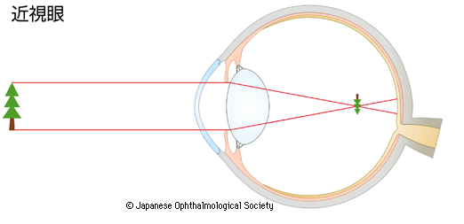 近視眼