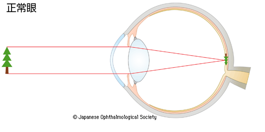 正常眼